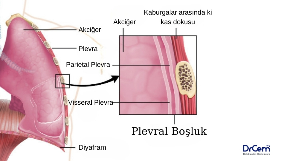 Ampiyem görseli - DrCem hastalık rehberi